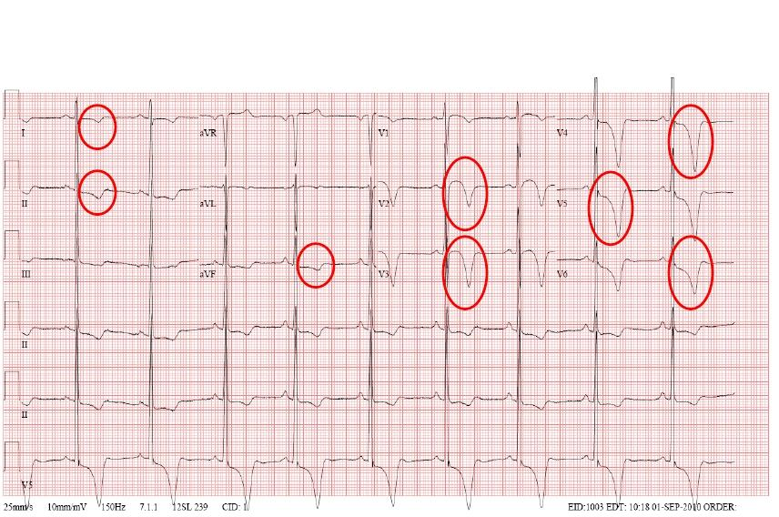 CMI Ragazzo di 22 anni, tennista con diagnosi di cardiomiopatia ipertrofica apicale.