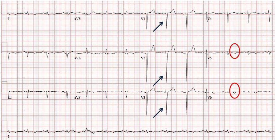 CMD L ECG rileva deviazione assiale sinistra, scarsa progressione dell onda R in