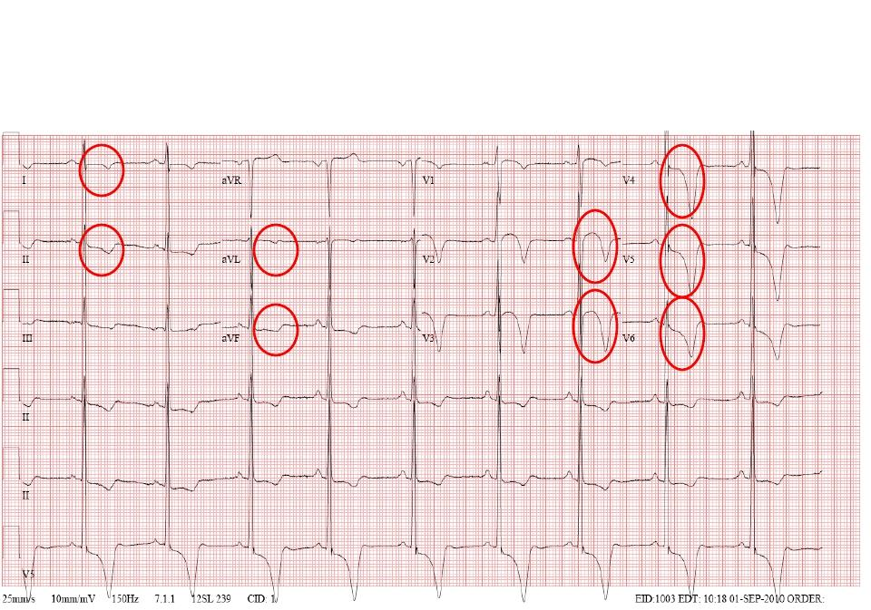 Anormale: Cardiomiopatia ipertrofica Da notare, oltre le R elevate nelle