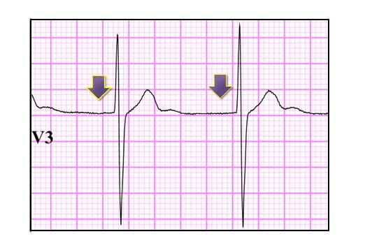 Risposta: B. Non fai nulla perchè si tratta di un ECG normale x l età L Ecg mostra un ritmo giunzionale. Nota il ritmo regolare con assenza di onde P (freccia) prima del QRS.