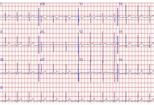 Un ragazzo di 12 anni, atleta, giunge al PS x dolore toracico, modificabile con gli atti del respiro, I genitori insistono perchè venga eseguito un ECG, in quanto a scuola, durante un evento