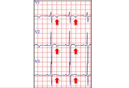 Risposta: D. Rassicuri il ragazzo ed i genitori L ECG mostra inversione dell onda T nelle precordiali destre normali per l età.