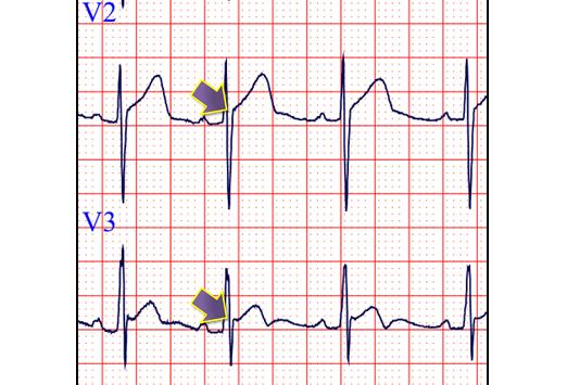 Risposta: A. Normale variante per l età Il sopraslivellamento del segmento ST, con innalzamento del punto J (frecce), presente nelle precordiali destre, è una variante frequente in età pediatrica.