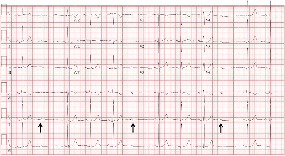 Blocco AV di 2 grado tipo Mobitz 1 (Wenckebach) L ECG rileva un blocco AV di 2 grado tipo Mobitz 1, notare il progressivo allungamento dell intervallo PR sino a quando un onda P, bloccata, non