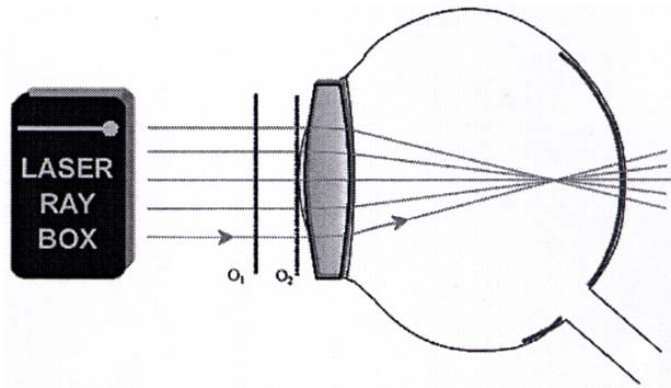 E22b Modello di occhio miope (U17300, pellicola A) I fasci luminosi paralleli all'asse ottico vengono interrotti dalla lente dell'occhio e si incontrano in un punto davanti alla retina.