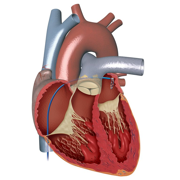 Catheter ablation Catheter ablation 2009 - Ablazione con catetere nella fibrillazione atriale