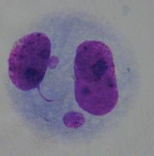 intatto e chiaramente distinto dal bordo citoplasmatico della cellula adiacente il diametro dei MN nei linfociti umani generalmente varia tra 1/16 a 1/3 del
