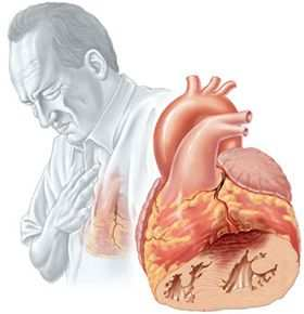 SCINTIGRAFIA MIOCARDICA CON ADENOSINA In regime di vasodilatazione coronarica massimale, farmacologicamente indotta, evidenza scintigrafica di grado severo a