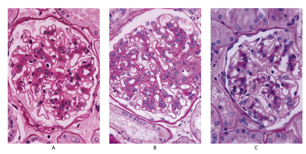 Photomicrographs of Renal-Biopsy Specimens Obtained before and after Pancreas Transplantation from a 31-Year-Old Woman with Type 1