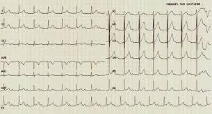 Anomalie della conduzione BAV Blocco AV I grado Intervallo PR prolungato Malattia reumatica, rosolia parotite, cardiomiopatie ECG ogni 6 mesi, holter e eco 1 volta l anno Età Pr msec 0-30 giorni