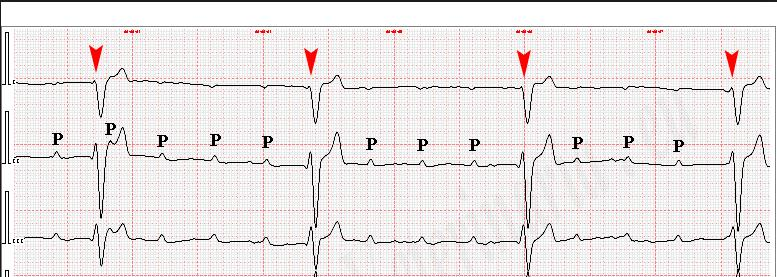 Cardiopatie :TCCGA; isomerismo sn, CAVc, CMP Acquisito Post