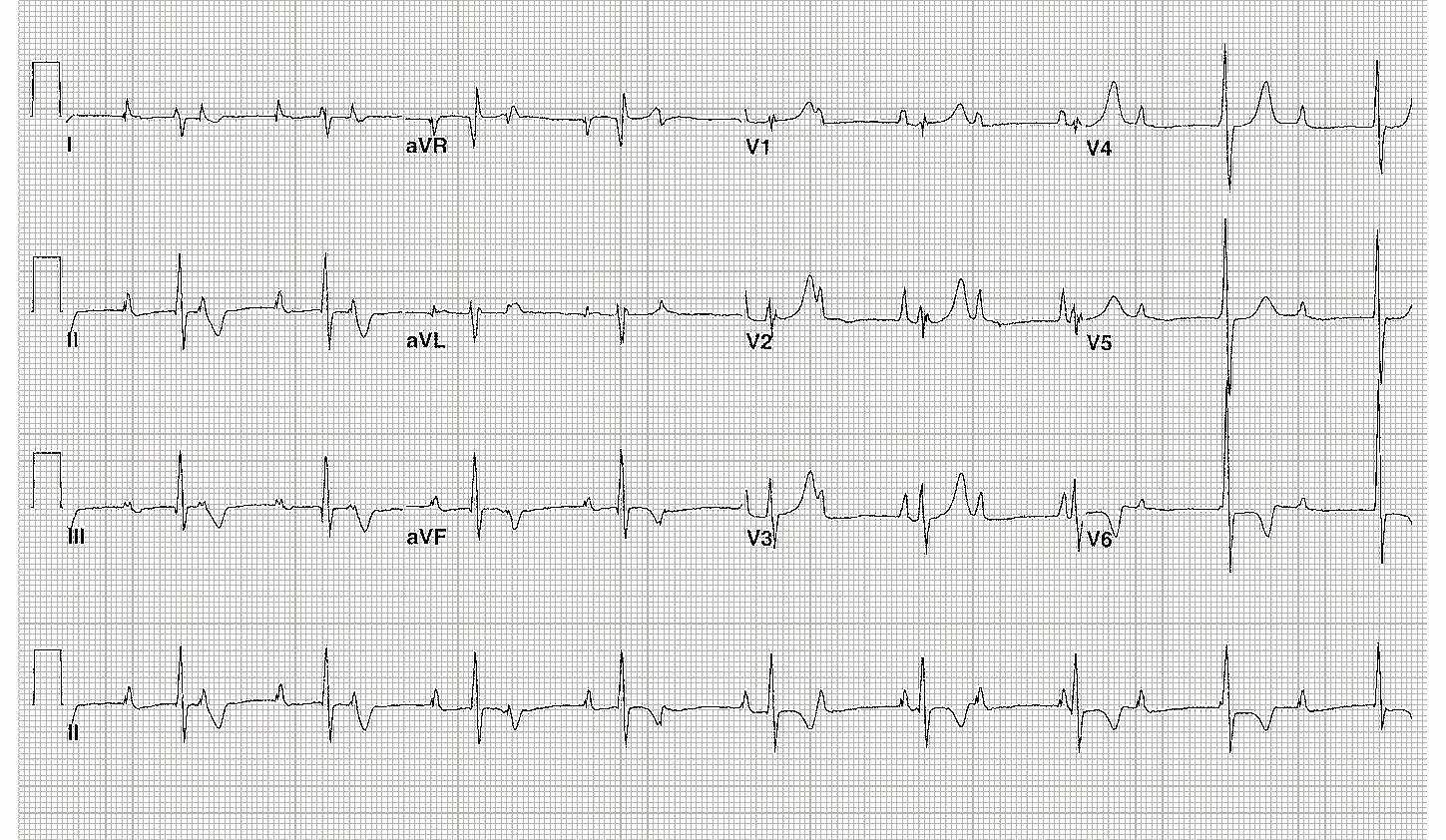 Può essere asintomatico follow up clinico Una FC bassa e la comparsa di ritmi di scappamento ventricolare costituiscono fattori di rischio-