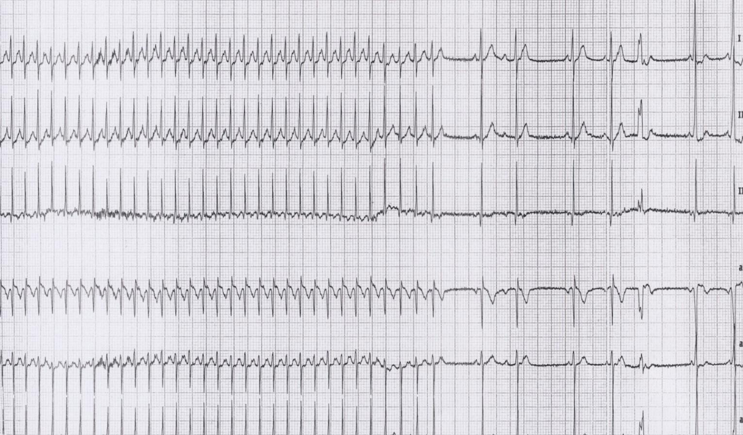 Adenosina uso terapeutico/diagnostico nelle TSV blocco transitorio conduzione AV efficace nelle TSV che