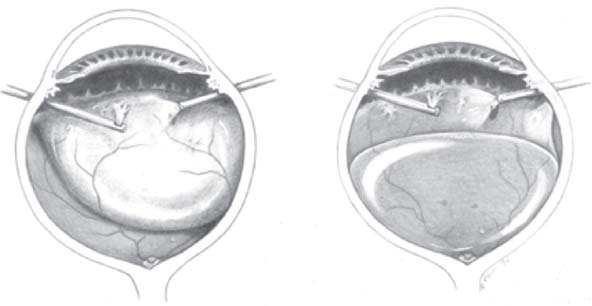 88 5 Ruolo della vitrectomia nella gestione primaria del distacco retinico Fig. 5.1. Nel distacco bolloso (a sin.