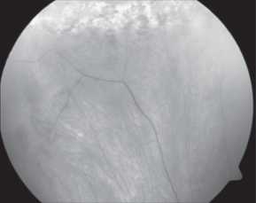 90 5 Ruolo della vitrectomia nella gestione primaria del distacco retinico Fig. 5.3. Larga rottura retinica posteriore sviluppatasi lungo una degenerazione a lattice retro-equatoriale (sinistra).