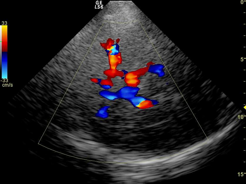 Progressing stroke-escluso