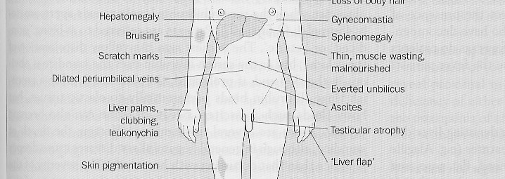 Splenomegalia?