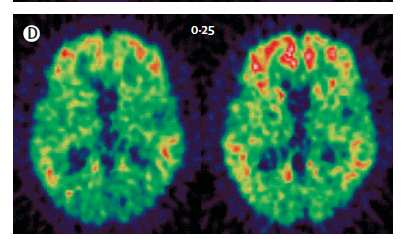 Analisi esplorative: decadimento cognitivo più lento nel gruppo trattato nei soggetti ApoE4-.(Salloway et al., 2009).