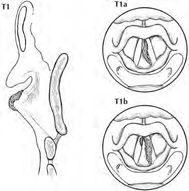 FIGURA 5.8. Le neoplasie T1 della glottide sono limitate alla/e corda/e vocale/i con normale mobilità (possono interessare la commissura anteriore o quella posteriore).