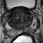 arrotondata, PI RADS 4 Area circoscritta di omogenea