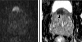 DWI; <1,5 centimetri sulle immagini assiali.