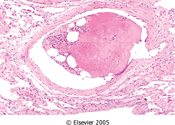 Downloaded from: Robbins & Cotran Pathologic Basis