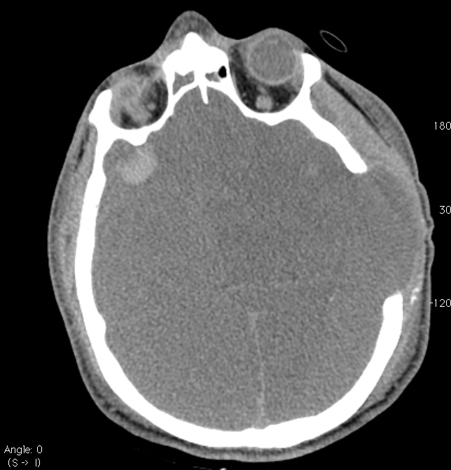 Angio TC - Arterie Pz di 38 aa Incidente motociclistico Apnea test Esame neurologico EEG non