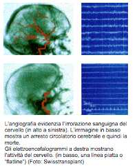 intra cranico. porzione petrosa circ.