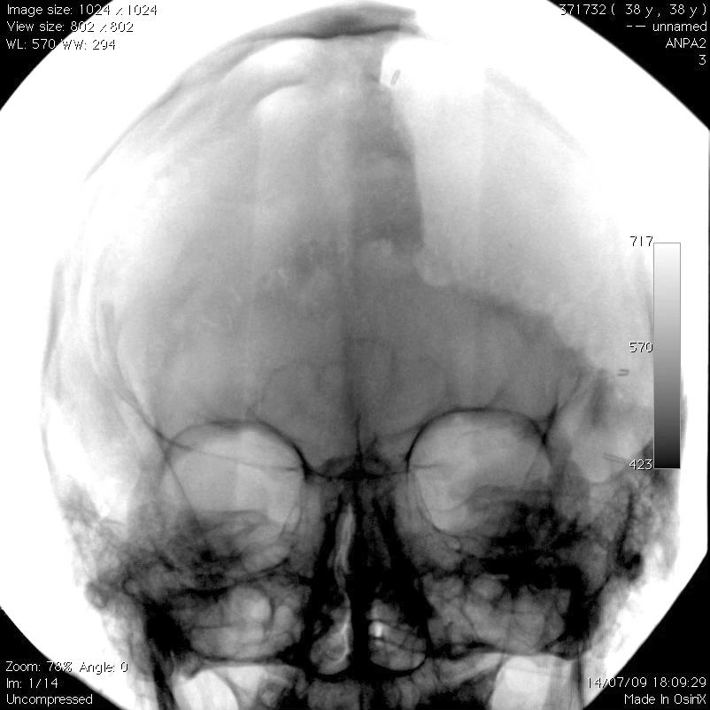 Angiografia Opacizzazione del seno longitudinale superiore non inficia il giudizio