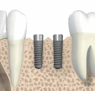 3. Pianificazione preoperatoria 1,