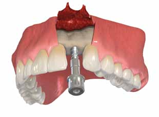 Passo 4 Inserimento dell impianto con il cricchetto Collegare il cricchetto e il perno della chiavetta di ritegno utilizzata come stabilizzatore.