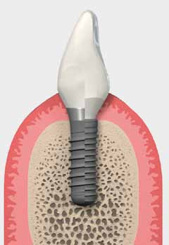 Conservazione ottimale dell osso crestale 1. Rispetto delle distanze biologiche 5 4a. Controllo del microgap Soft Tissue Level 4b.