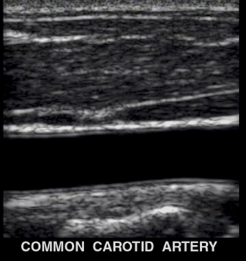 Carotid Artery