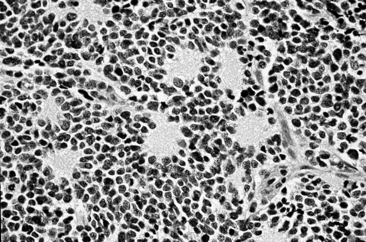 Foto microscopica di neuroblastoma composto da piccole