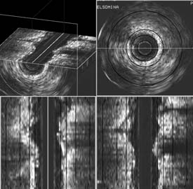 Su ogni immagine IVUS è stata eseguita una procedura di segmentazione della placca e dello stent e una sovrapposizione della curva isodose corrispondente al 100% della dose prescritta a 2mm.