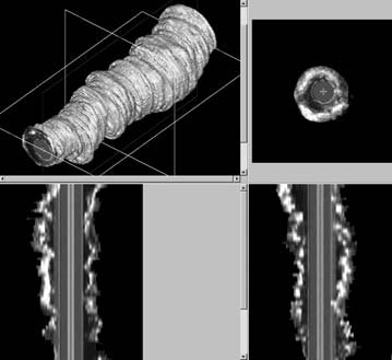 Le figure 3 e 4 sono ricostruzioni longitudinali del vaso: il catetere lungo il suo percorso si posiziona in modo eccentrico rispetto alle pareti del vaso.