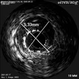 dovrebbe essere prescritta in un punto clinicamente rilevante, determinabile in modo accurato e semplice mediante procedure angiografiche; 2 livello ( tecniche 2D ) la dose dovrebbe essere