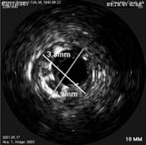 diametro minimo del lume (mld) lunghezza della lesione lunghezza trattata 3 livello ( tecniche 3D ) la dose dovrebbe essere prescritta basandosi su elaborazioni 3D ( immagini IVUS ) con