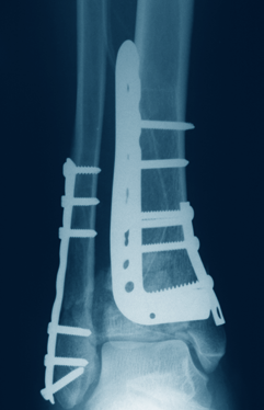 Tecnica chirurgica LCP Small Fragment System Questa