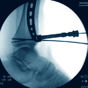 Inserimento delle viti 5 Opzione: verifica della posizione della vite Strumenti X92.710 Filo di Kirschner da B 1.6 mm con punta filettata 310.284 Punta elicoidale LCP da B 2.8 mm 323.