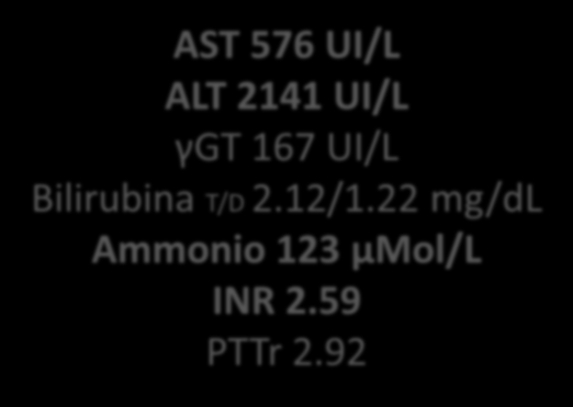 89 mg/dl AST 576 UI/L ALT 2141 UI/L γgt 167 UI/L