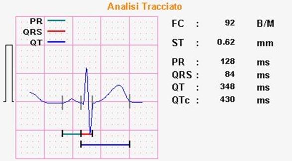 aritmia ed è stato sempre possibile calcolare la