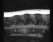 In fase acuta il focolaio infettivo in sequenze T1 appare come un ipointensità nella spongiosa di due corpi vertebrali adiacenti al disco interessato con irregolarità delle limitanti somatiche che