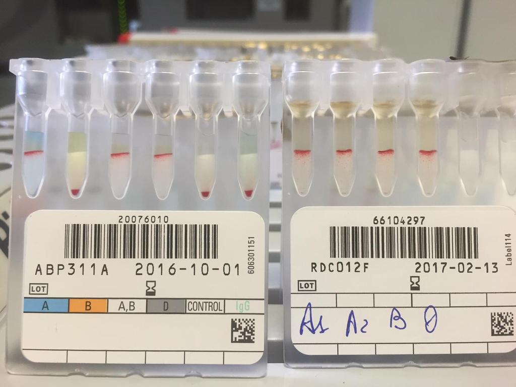 Presenza di anticorpi In caso di incongruenza tra prova diretta ed indiretta, con agglutinazione inattesa delle cellule screening, occorre in primis effettuare una ricerca