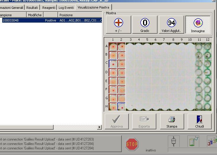 CASO CLINICO N. 1 Donna di 86 anni, mai trasfusa, plurigravida, identificata n. 100033048 Gruppo A POS ccdee Positiva al Capture-R Ready Screen (4).