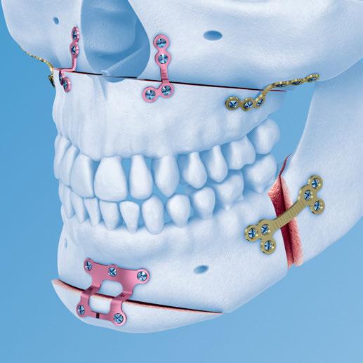 MatrixORTHOGNATHIC. Impianti e strumenti specifici per la chirurgica ortognatica.