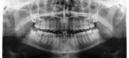 Radiografia panoramica di tutta la dentatura (OPT) Teleradiografia Tomografia