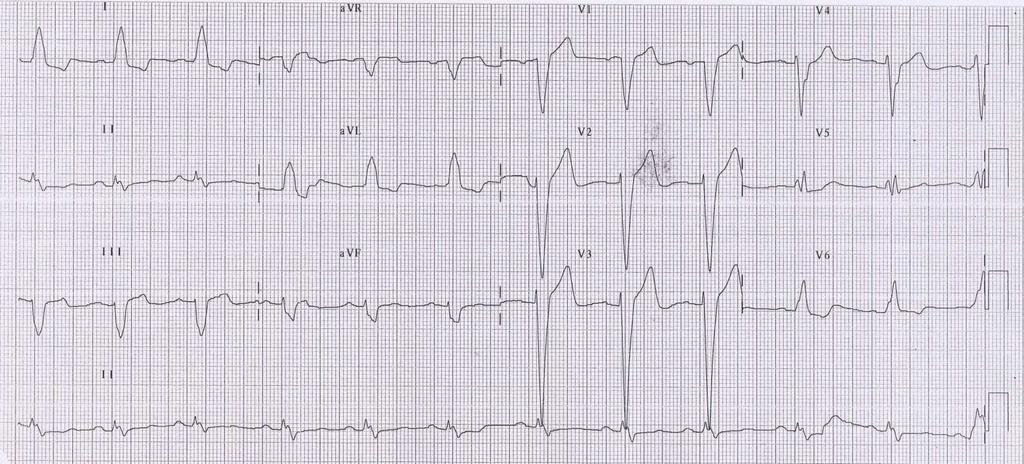 ECG