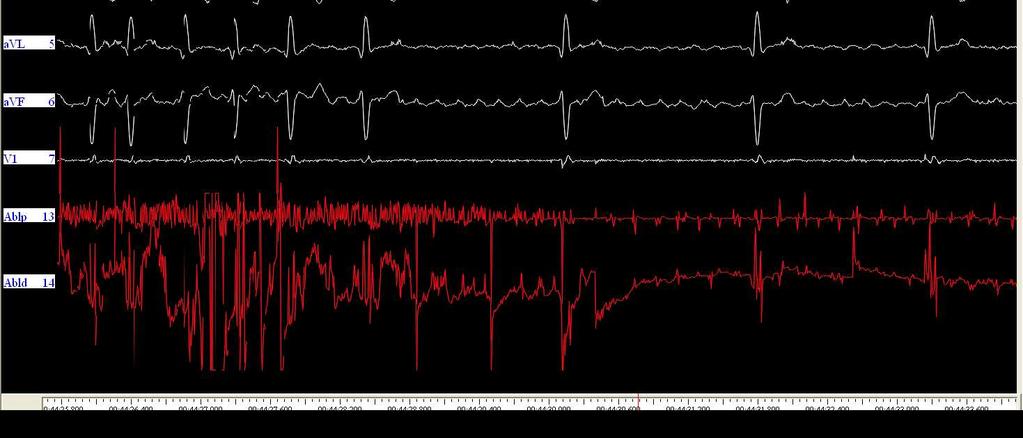 farmacologica volta al controllo della frequenza cardiaca.