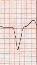 QRS stimolato 189 msec Elettrocardiogramma ECG: